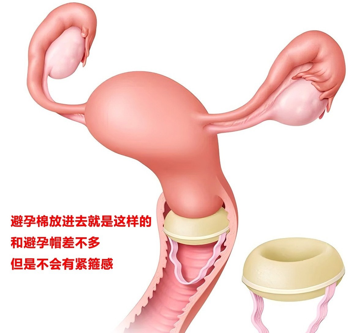 避孕棉原理.jpg